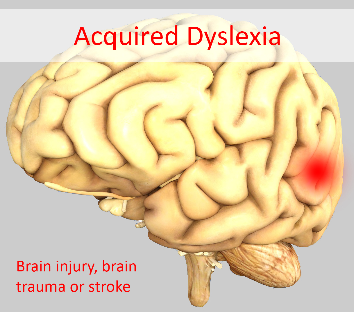 BrainInjury_ | Stark Griffin Dyslexia Academy